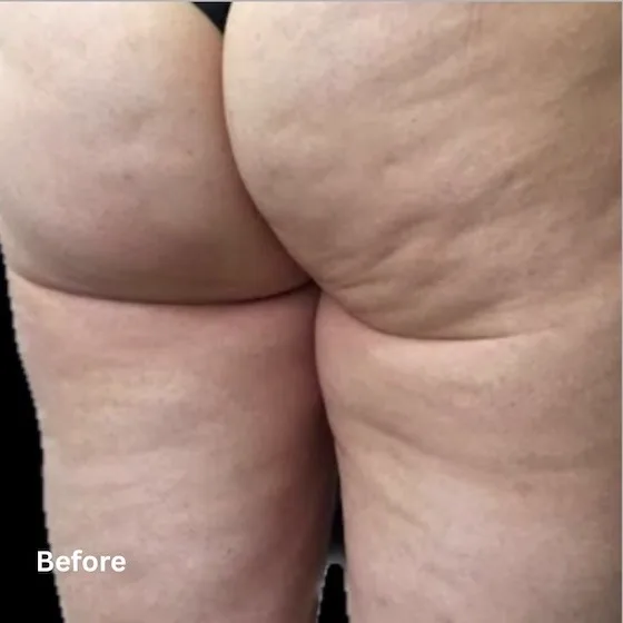 Thighs before cellulite reduction treatment