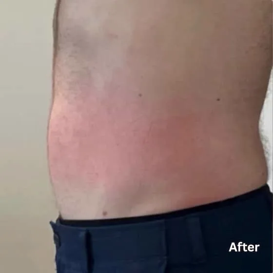 Abdomen after fat reduction treatment
