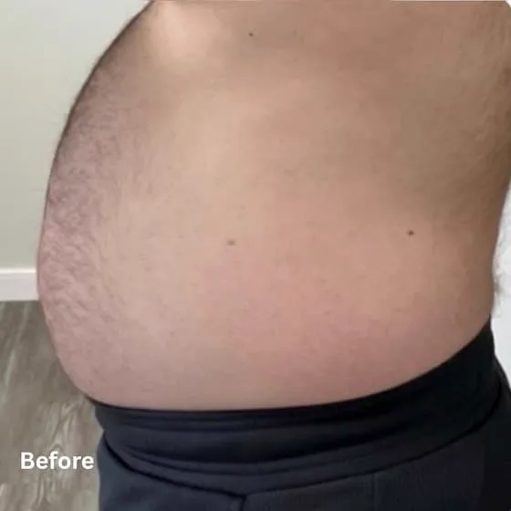 Abdomen before fat reduction treatment
