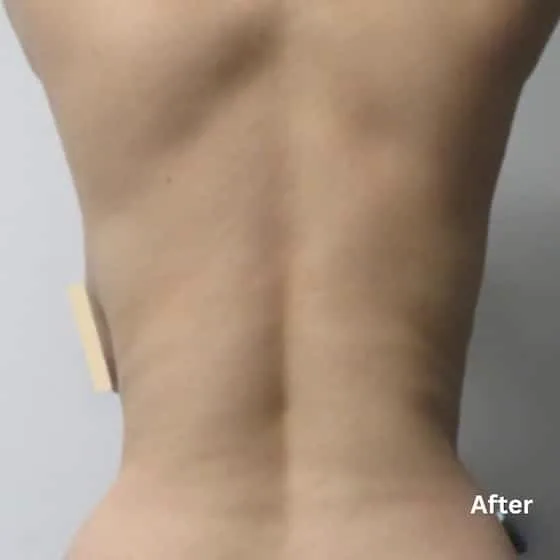 After skin tightening treatment
