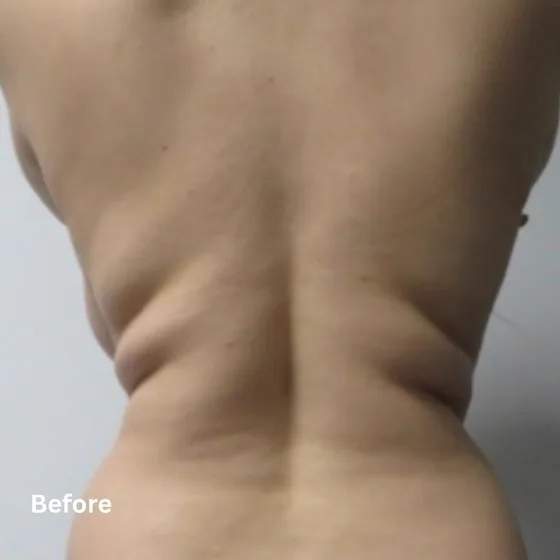 Before skin tightening treatment